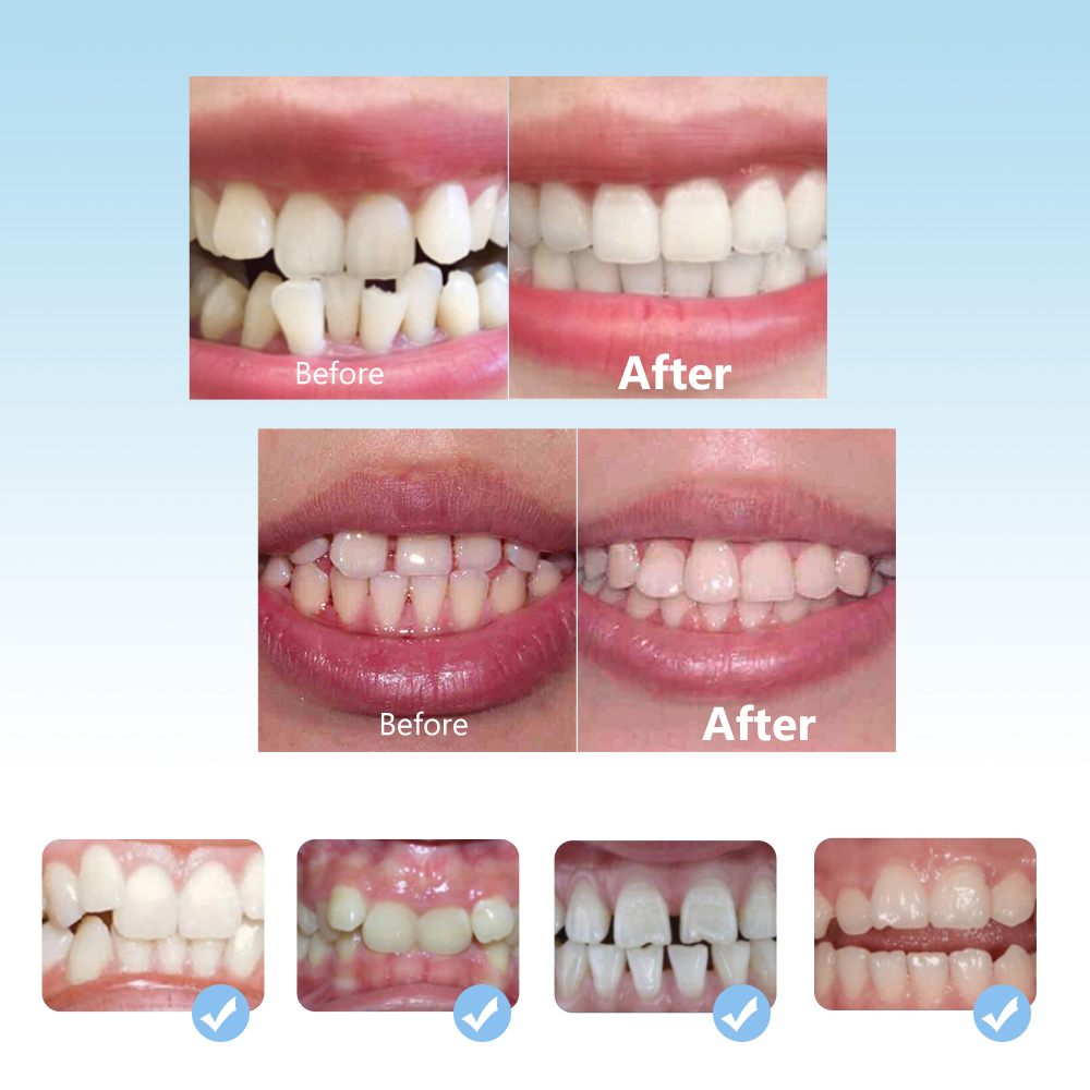 Dental Orthodontic Braces Set  - Teeth Whitening With Braces recension och pris