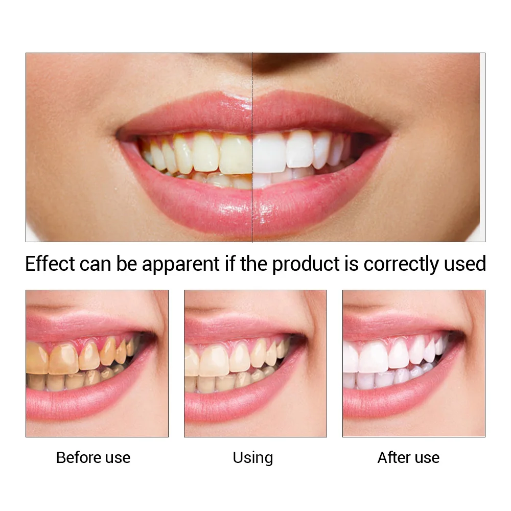 FTEENPLY Teeth Whitening Essen - Teeth Whitening (Bleaching) recension och pris