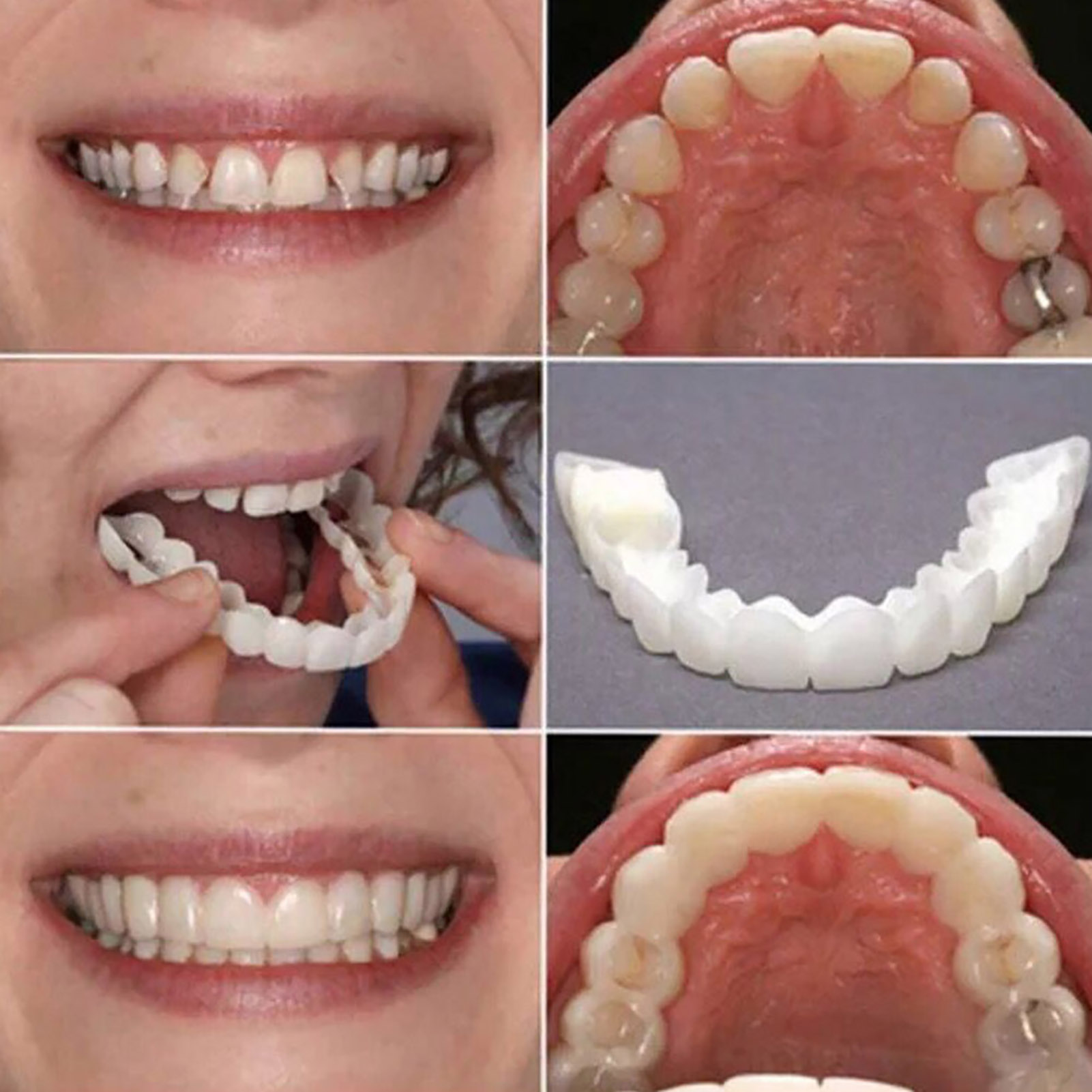 Hot Teeth Veneers Whitening De - Teeth Whitening For Braces recension och pris