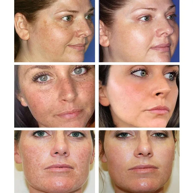 Whitening Freckle Cream Remove - Charcoal Whitening Paste recension och pris