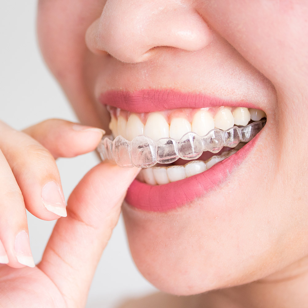 2/4pcs Mouth Guard Teeth Prote - Teeth Whitening For Trays recension och pris